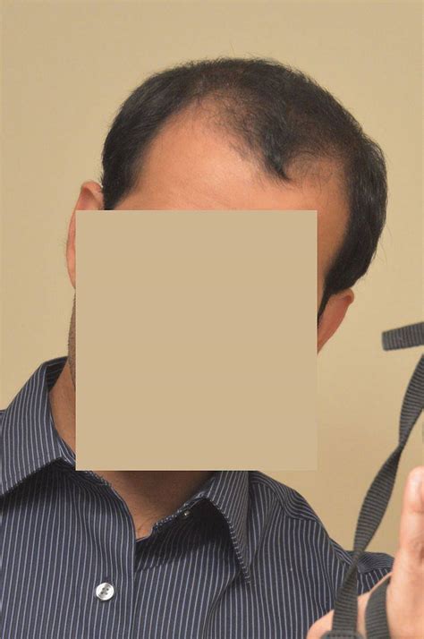phantom 777 review|Patient phantom777's hair transplant review.
